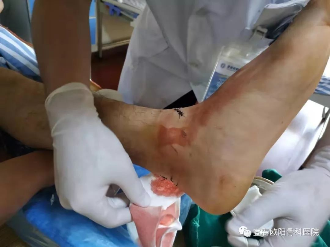 少年腳跟被玻璃割裂，手足外科醫(yī)師緊急手術(shù)
