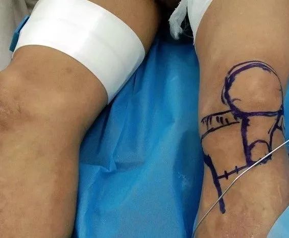 我院保膝治療又獲成功，關(guān)節(jié)病患者的福音！